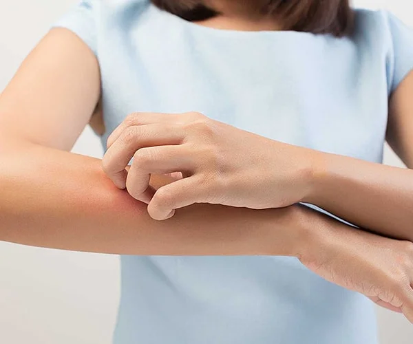 Dị ứng da khi sử dụng đệm giá rẻ kém chất lượng